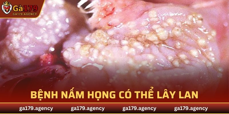 Bệnh nấm họng là căn bệnh có thể lây lan