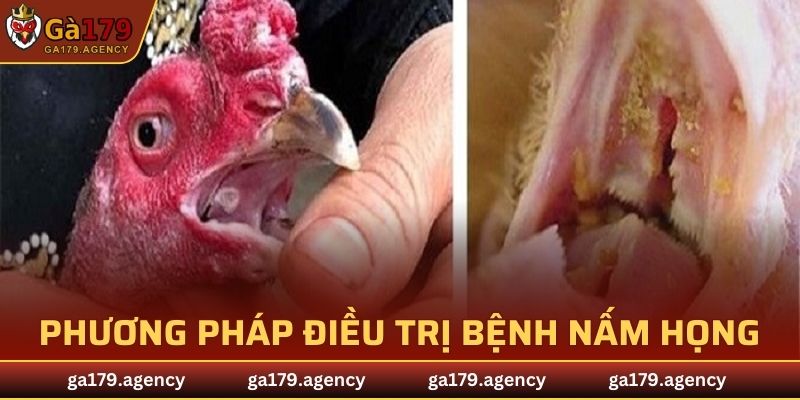 Phương pháp điều trị bệnh nấm họng cực hiệu quả